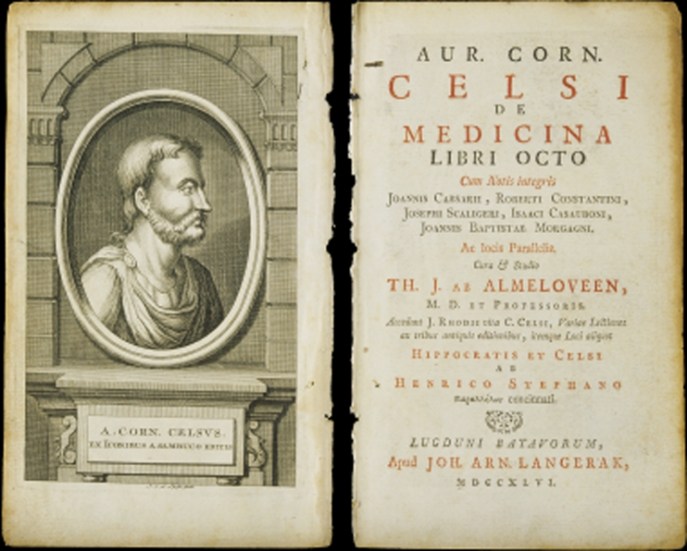 上图:塞尔苏斯(Aulus Cornelius Celsus,主前25-主后50年)编纂的百科全书《医术 De Medicina》。在这本书中提到希腊文称为elephantiasis graecorum的疾病,症状与现代的麻风病相似。但主前3-2世纪的希腊文七十士译本却把「大麻风 צָרַעַת」译为Λέπρα(lepra),意思是「使皮肤有鳞的病」。主后5世纪耶柔米(Jerome)在翻译拉丁文武加大译本时,也没有使用学名elephantiasis graecorum,而是使用lepra的音译,表明他并不认为lepra就是麻风病,而只是一种恶性皮肤病。从lepra转变来的英文leprosy,后来被用来称呼「麻风病 Hansen's Disease」。